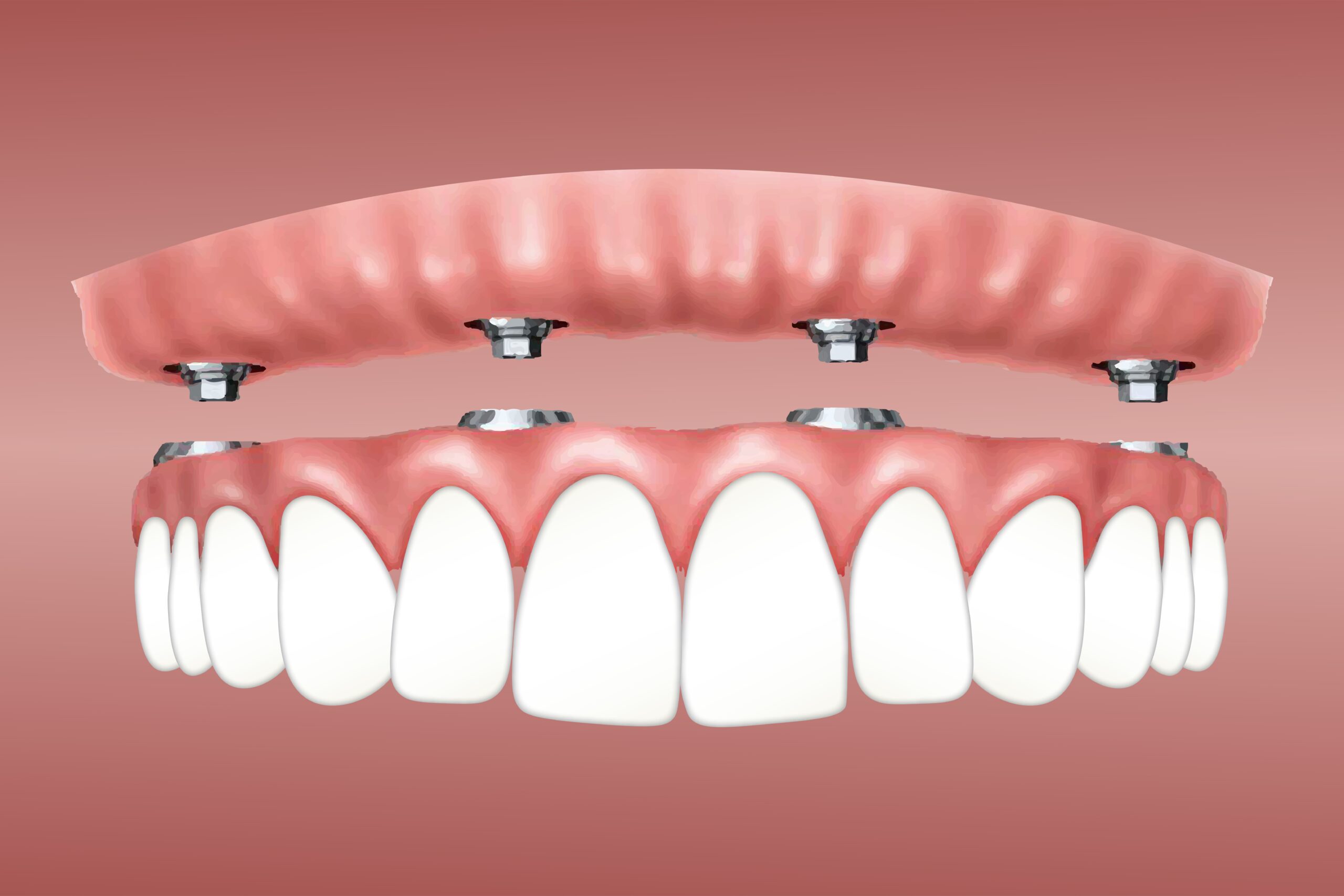 Implants timisoara
